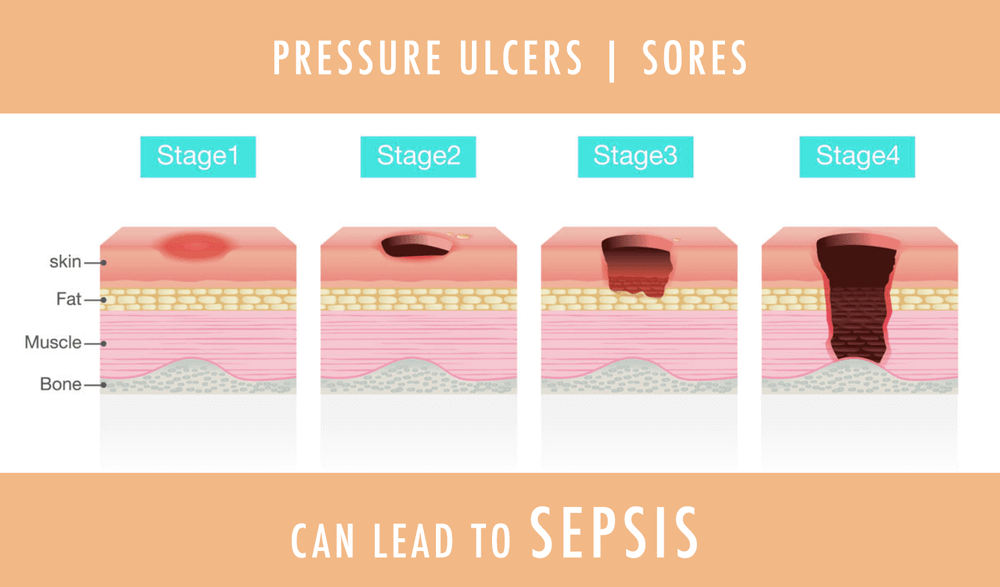 How to Prevent Pressure Ulcers or Bed Sores